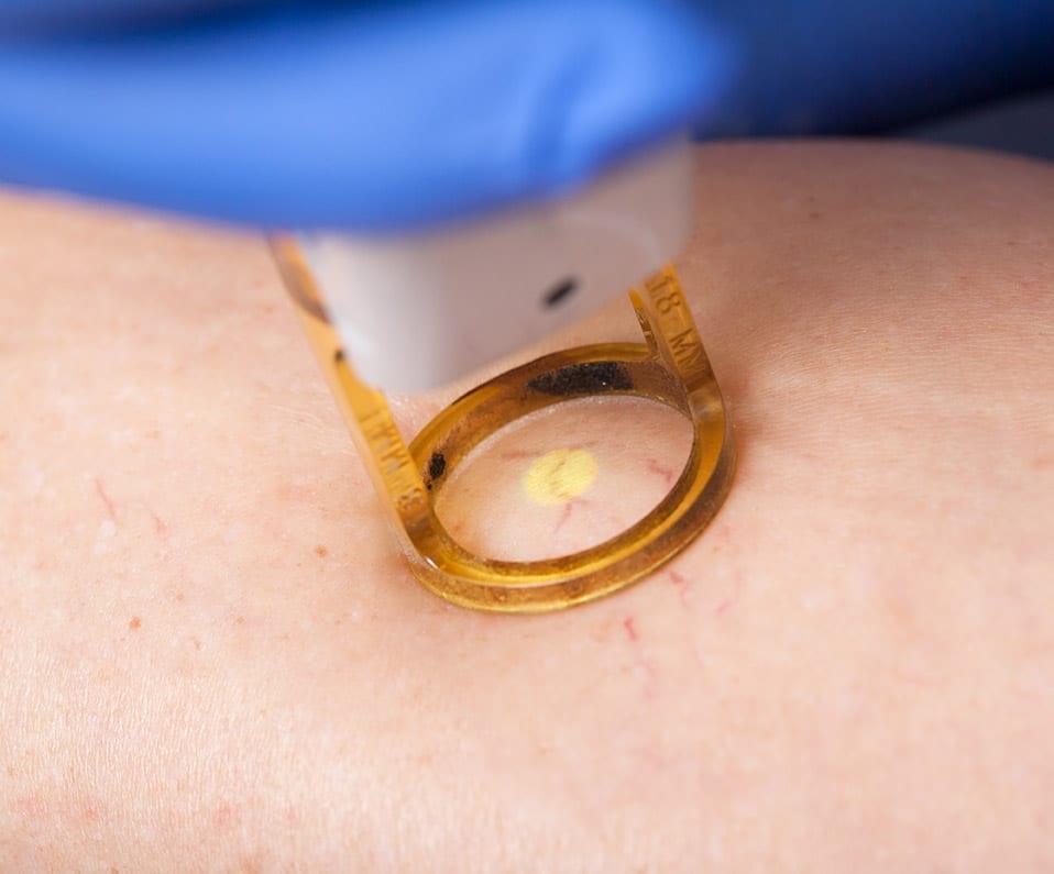 varicose vein removal varicose vein removal
