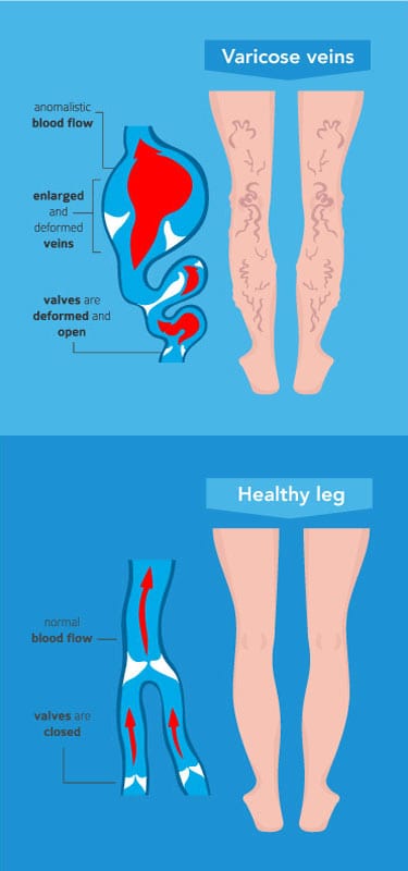 VARICOSE-VEIN-ANIMATED-mobile